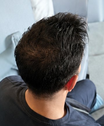 Scalp at follow-up — fuller coverage at the crown