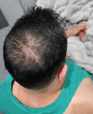 Scalp before treatment — thinning at the crown
